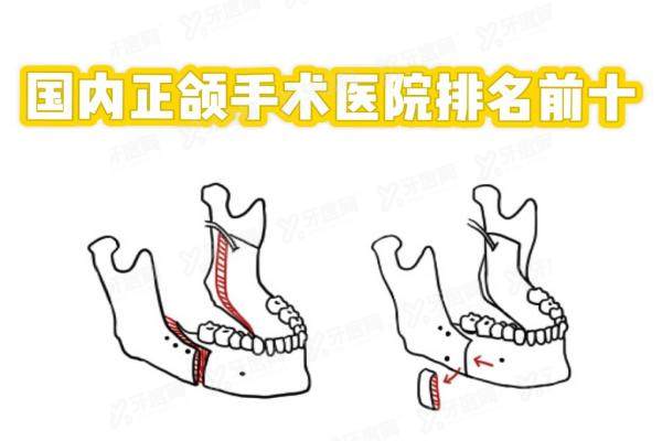 国内正颌手术医院排名前十：广州广大|上海时光等多家正规医院上榜