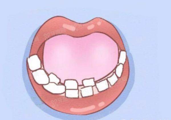 孩子双排牙怎么形成的？乳牙滞留导致要及时干预