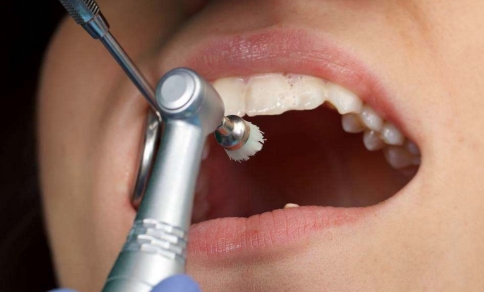 洗牙抛光和喷砂的区别：基于清洁程度/方法不同来保护牙齿