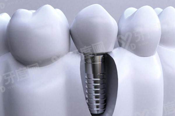 宝鸡团圆口腔医院种植牙价格表？公开透明！国产种植 1980 元起 + 韩系种植 2980 元起，种植牙成活率高超放心！