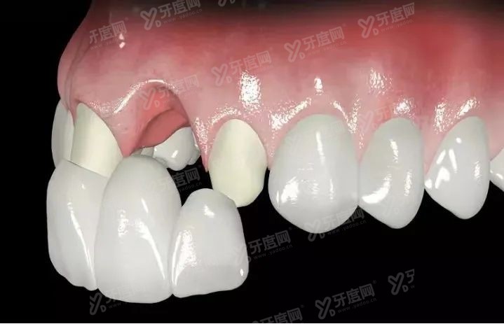牙齿缺失一定要种植牙吗？来看牙齿缺失的几种修复方法及优缺点