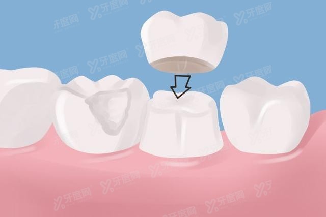 根管治疗做牙冠还是嵌体好，牙体缺失大牙冠更好