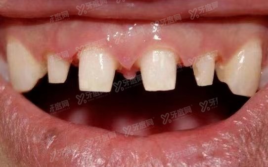 七天矫正牙齿是真的吗?假的!牙齿矫正快的要三个月到半年