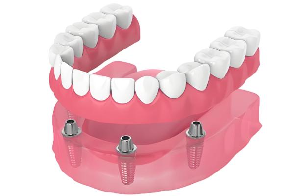 德国zuga种植体和德国acm种植体哪个好？后牙承重选zuga，前牙美学修复选acm！抗咬合力强 + 亲水层颜值在线