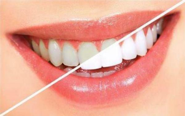 洗牙和牙齿美白一样吗?不一样,洗牙和牙齿美白不是一回事