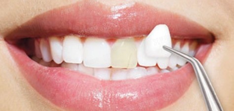 为什么医生不建议做牙齿贴面治疗？做了牙齿贴面好后悔呀