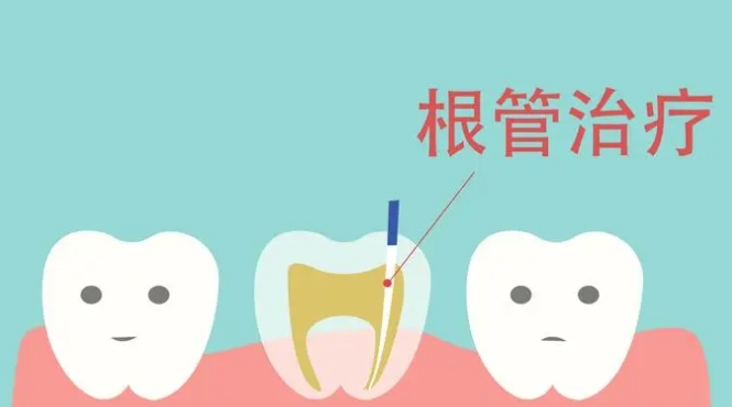 牙髓炎能自己痊愈吗？不能，那牙髓炎应该如何治疗？