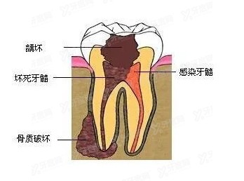 深龋是做根管治疗还是补牙好呢，当然是根管治疗更有优势