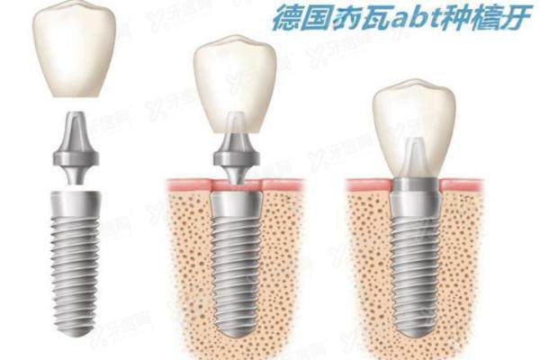 德国卡瓦ABT种植体怎么样？材质/型号/价格/质保等深度解析