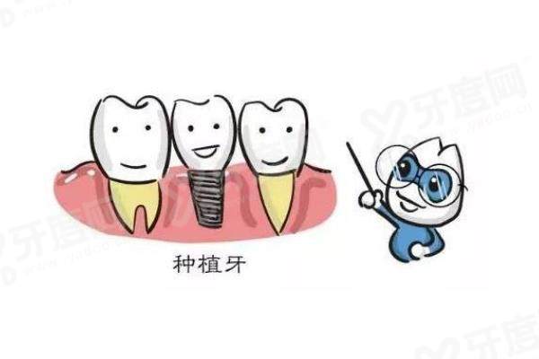 创英种植体是哪个国家的？它是国产的！种植牙质量可靠且价格不贵