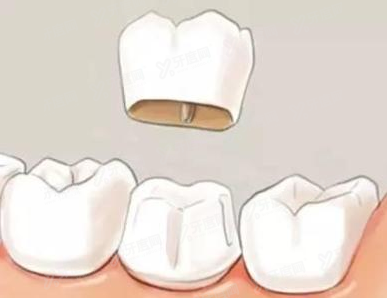 根管治疗后需要做牙套吗？需要，来看戴牙冠的全过程