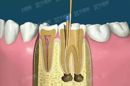 根管治疗到底有效吗？牙齿根管治疗的方法