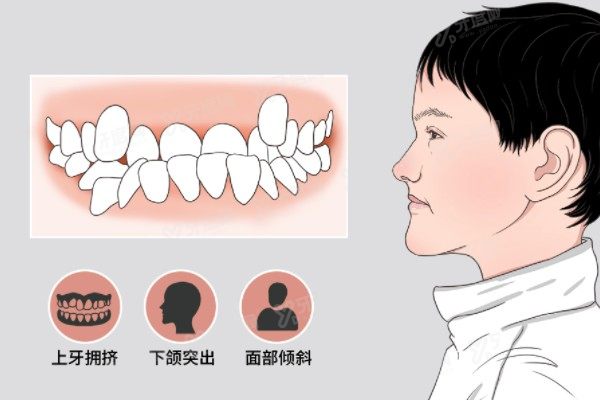 地包天牙性和骨性区别：病因|矫正步骤等均有不同，含自测方法
