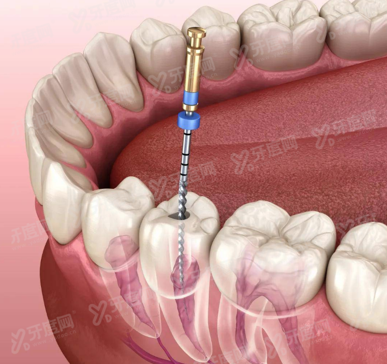 老年人能做根管治疗但难度大，治疗后的注意事项要记牢!