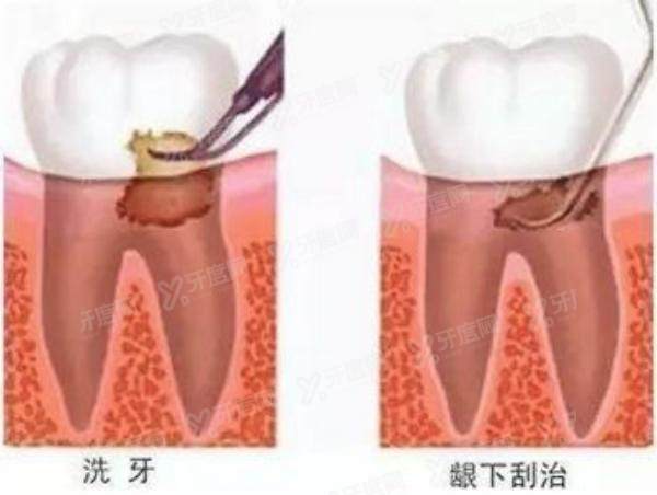 洗牙和牙周刮治的区别，洗牙好还是牙周刮治好？