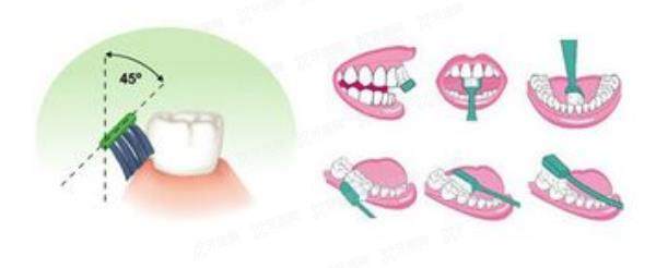 因刷牙方式不当引起的牙龈萎缩怎么办?来试试改良巴氏刷牙法!