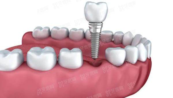 许昌种植牙医院排名前十：赛尔/植得/德菲口腔排名前三