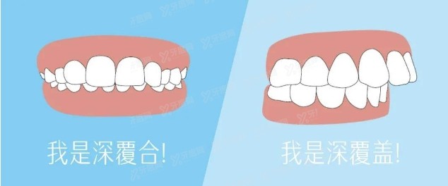 牙齿深覆合和深覆盖的区别在哪里？两者该如何矫正