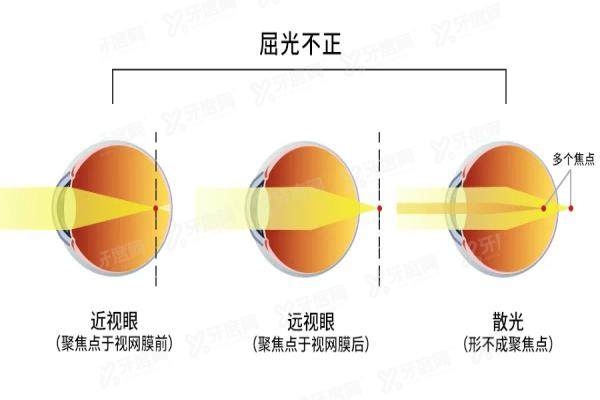 屈光不正和近视眼的区别是什么.jpg