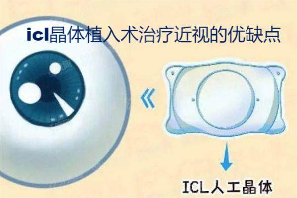 icl晶体植入术治疗近视的优缺点.jpg