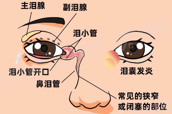 急性泪囊炎一定要做手术吗?.jpgyk.yadoo.cn 急性泪囊炎一定要做手术吗?.jpgyk.yadoo.cn