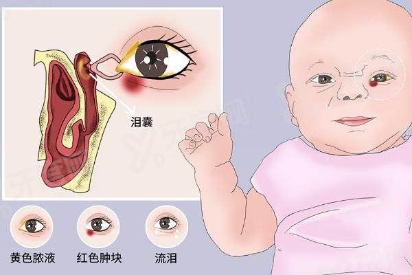 急性泪囊炎一定要做手术吗?.jpg 急性泪囊炎一定要做手术吗?.jpg