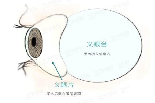 2024爱尔眼科义眼片价格yanke.yadoo.cn