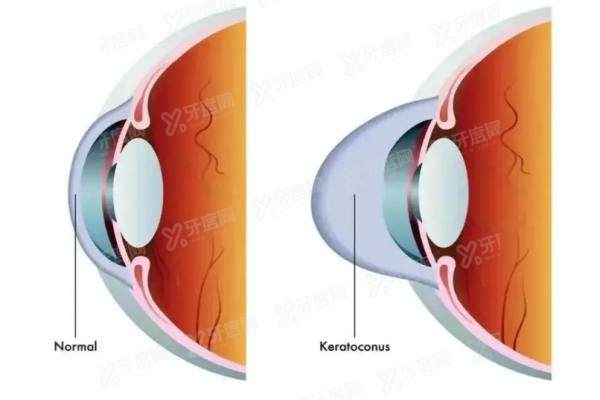 圆锥角膜手术费用多少？2万起可报销，附国内做圆锥角膜手术好的医院