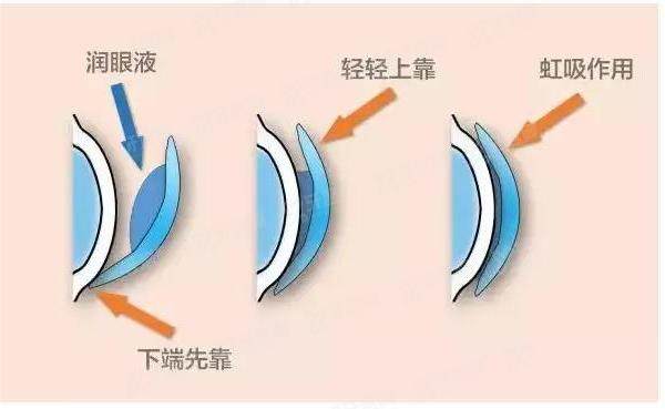 【角膜塑形镜十大品牌价格公布】普诺瞳|亨泰|阿迩法ok镜大概多少钱yanke.yadoo.cn.jpg