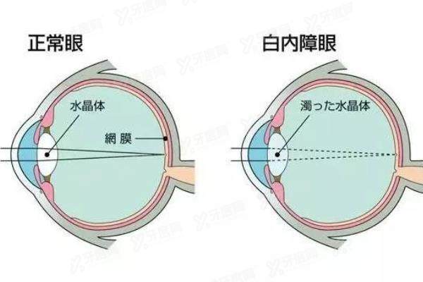 乌鲁木齐市友谊医院眼科白内障手术费用公示:仅5800元起可以报销技术好yk.yadoo.cn.jpg