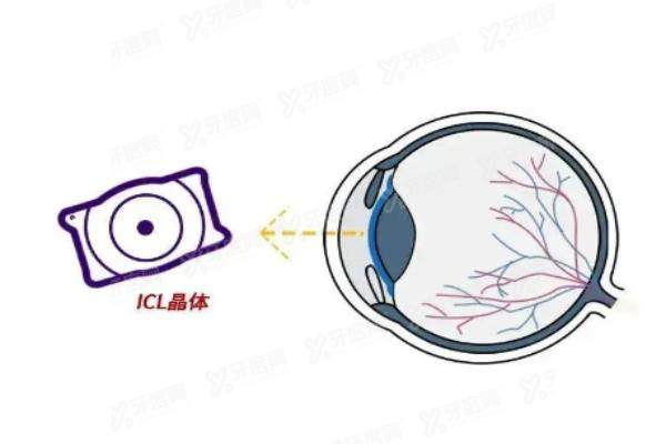 上海晶体植入近视手术费用：爱尔/新视界/和平眼科2.9w起,技术好