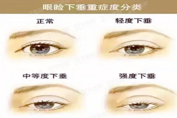 yanke.yadoo.cn上眼睑下垂怎么治疗.jpg