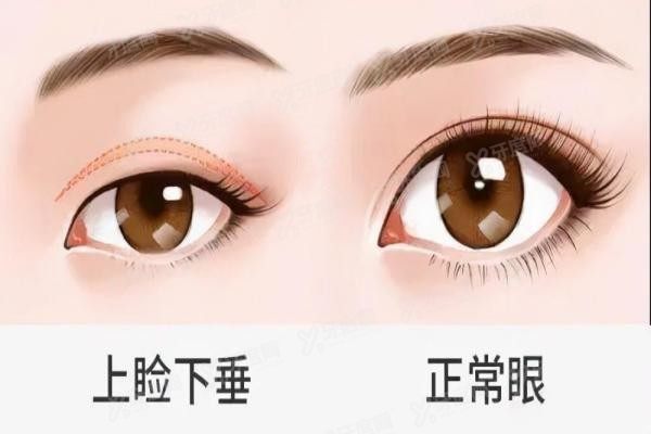 yanke.yadoo.cn上眼睑下垂怎么治疗.jpg