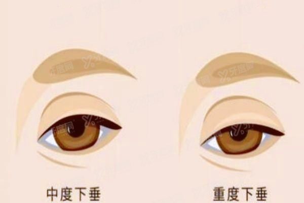 yanke.yadoo.cn上眼睑下垂怎么治疗.jpg