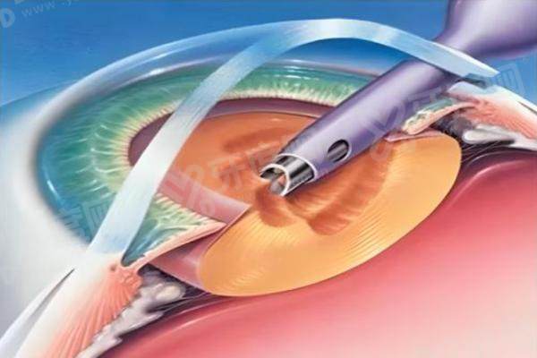 跃无极人工晶体优缺点yanke.yadoo.cn 跃无极人工晶体优缺点yanke.yadoo.cn