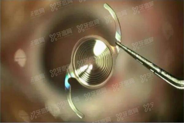 爱尔康三焦点人工晶体多少钱yanke.yadoo.cn