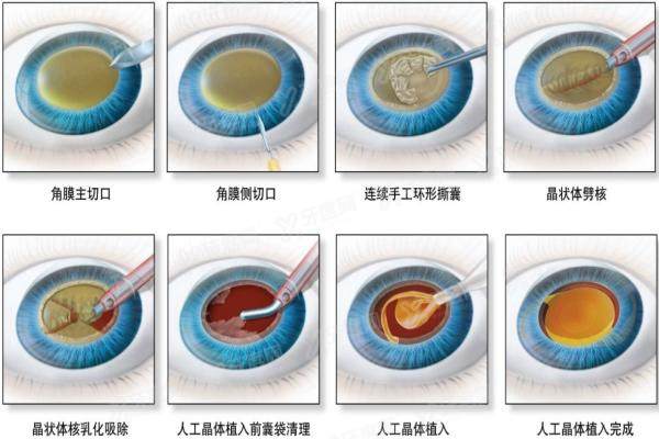 爱尔康三焦点人工晶体手术后多久可以看电脑yanke.yadoo.cn