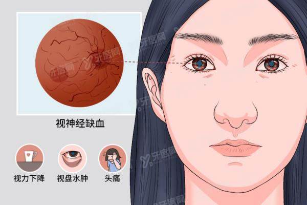 视神经萎缩有救了yanke.yadoo.cn