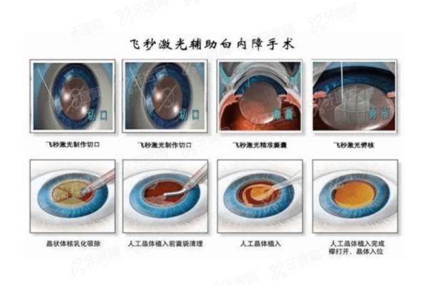 飞秒白内障手术和普通白内障手术费用yanke.yadoo.cn