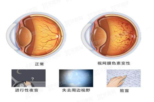 视网膜色素变性哪家医院治疗好yanke.yadoo.cn