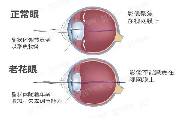 老花眼矫正手术多少钱？yk.yadoo.cn