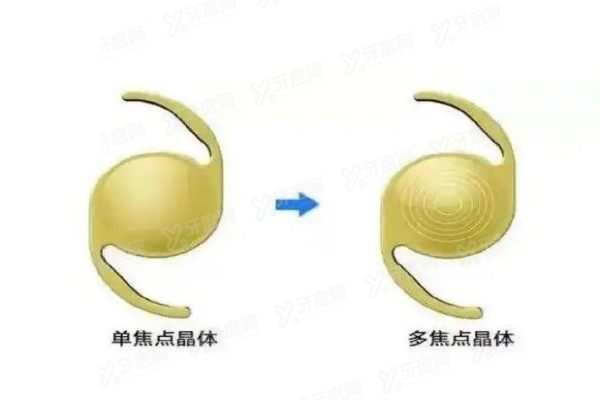 yanke.yadoo.cn单焦点人工晶体和多焦点人工晶体的区别1.jpg