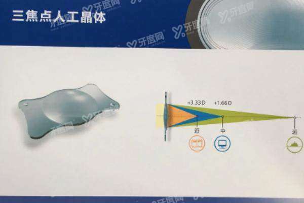 白内障做三焦点人工晶体好吗yanke.yadoo.cn