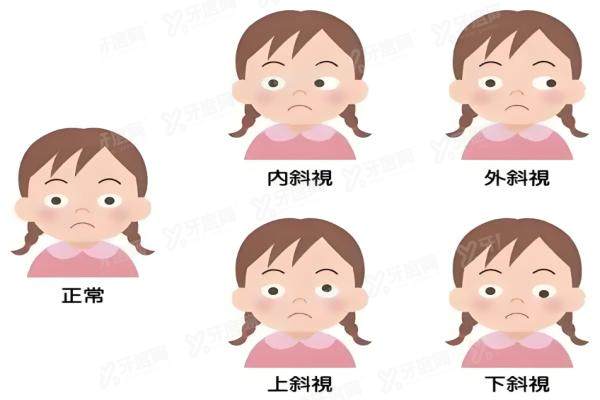 爱尔眼科医院斜视手术怎么样yanke.yadoo.cn