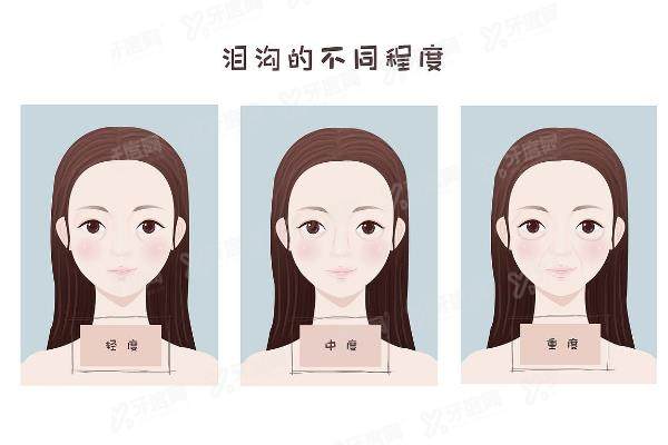泪沟是怎么形成的yimei.yadoo.cn