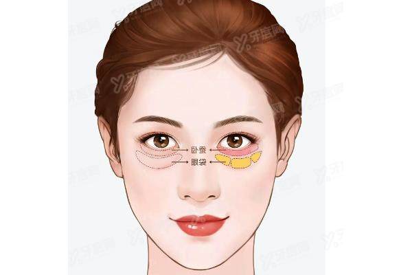 卧蚕用什么填充好yimei.yadoo.cn