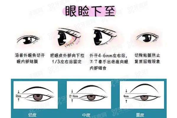 眼睑矫正手术是什么意思yimei.yadoo.cn
