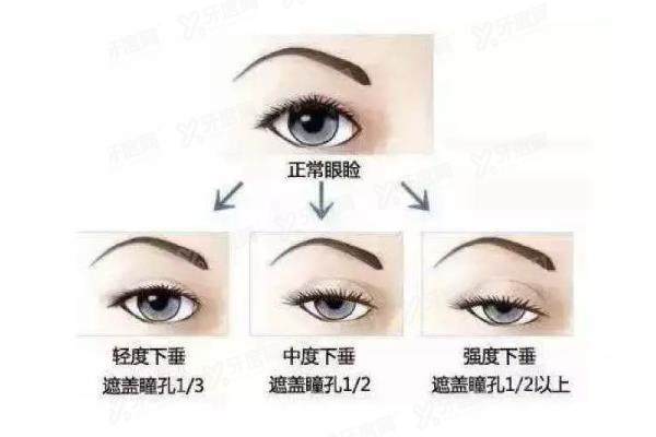眼睑矫正手术有哪些方法yimei.yadoo.cn