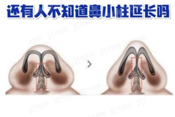 鼻小柱延长手术yimei.yadoo.cn