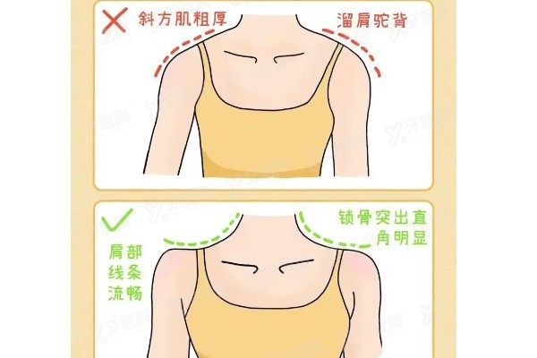 超声溶脂瘦肩部yimei.yadoo.cn.jpg
